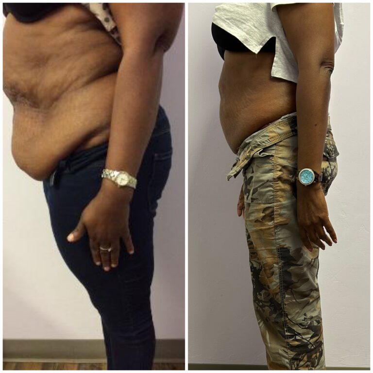 Before and after Fat-freezing Emerald procedure before and after at Petra's Weightloss Clinic.