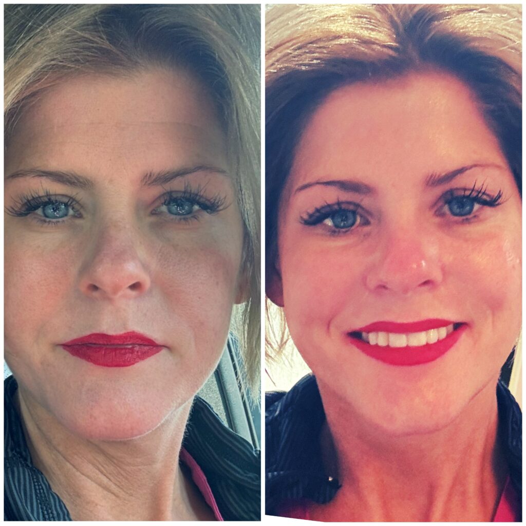 Monopolar Procedure before and after showing tighter skin in the face of a woman.