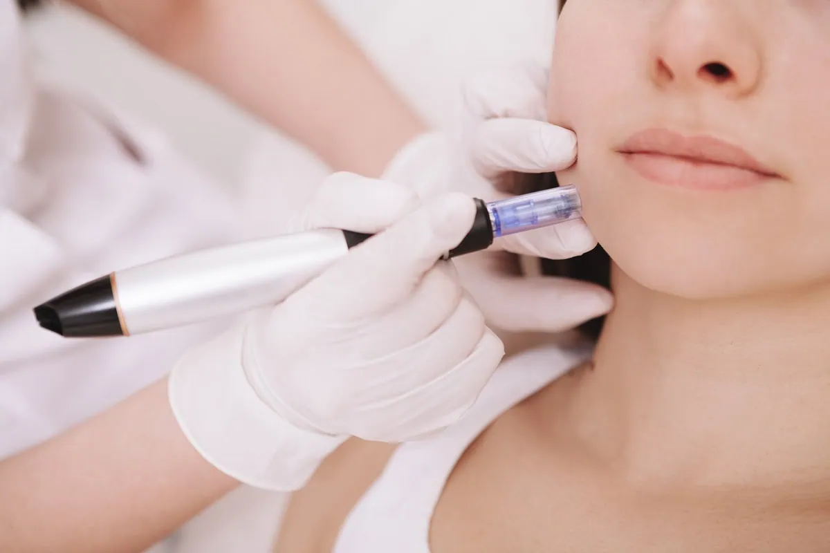Microneedling device applied to face in Oklahoma City, OK