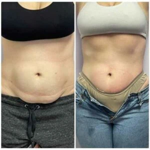Abdominal area after six sessions of cavitation | before and after.