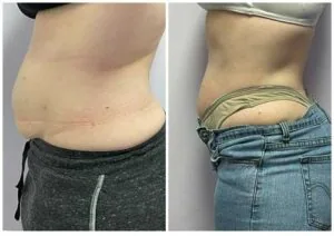 Lower abdomen body contouring results | before and after photo.