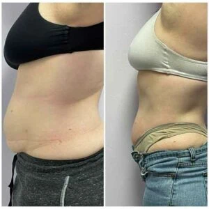 Clinical belly fat reduction transformation | before and after session results.