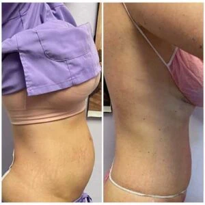 Visible belly fat loss after cavitation treatment | before and after image.