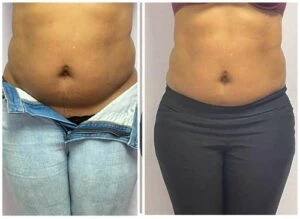 Tummy fat before and after ultrasonic cavitation session.