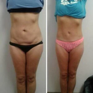 Side profile showing belly reduction before and after treatment.
