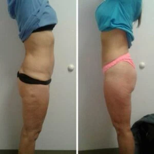 Abdomen and hip area before and after body shaping session.