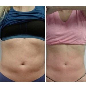 Abdomen before and after non-surgical fat reduction treatment.