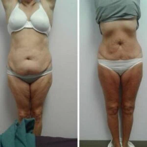 Female lower stomach before and after fat melting session.