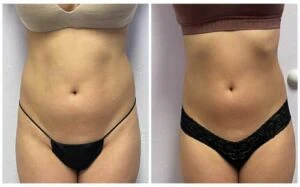Female abdomen before and after cavitation slimming procedure.