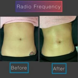 Overall body contouring visible in before and after shots.