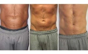 Male stomach showing before and after body contouring results.