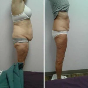Waist shape before and after non-surgical treatment.