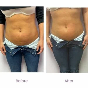 Woman’s waistline before and after fat reduction sessions.