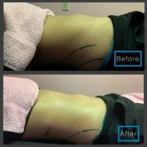 Woman showing skin tightening before and after radio frequency session.