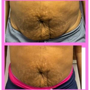 Visible skin tightening results with before and after photos.