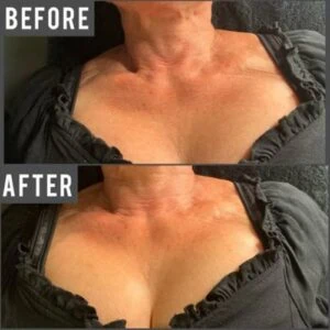 Non-surgical chest tightening before and after treatment results.