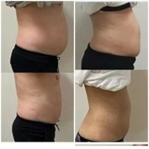 Toned stomach area before and after a non-surgical treatment.