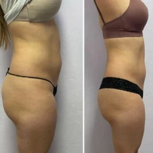 Abdomen contouring results displayed in before and after photo.