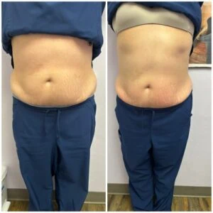 Abdominal transformation with before and after comparison in black shorts.