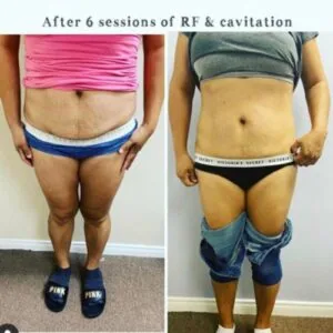 Visible change in belly size—non-surgical fat loss before and after.