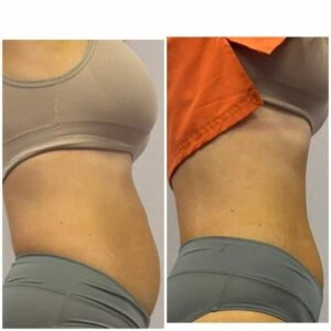Woman in jeans, side-by-side, before and after fat loss procedure.