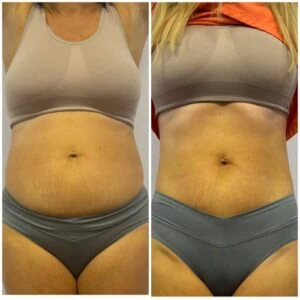 Woman’s waist and lower abdomen before and after treatment.