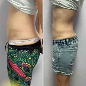 Belly and waistline improvement in before and after session image.