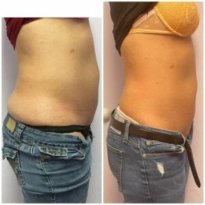 Stomach area before and after visible reduction of fat.