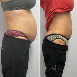 Stomach and waist before and after visible fat reduction.