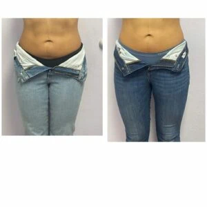 Woman's torso before and after body shaping procedure.