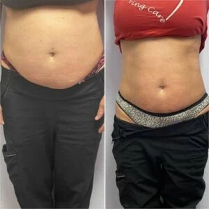 Abdomen and hip area before and after cavitation procedure.