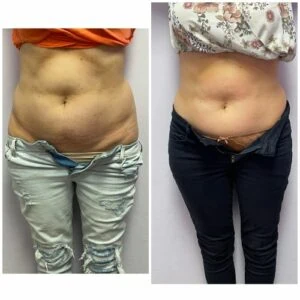 Two women in before and after waist slimming treatment.