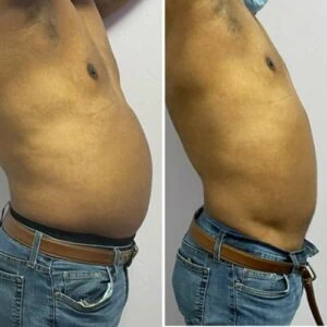 Male side profile showing before and after waist contouring.