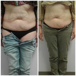 Midriff before and after visible toning procedure.