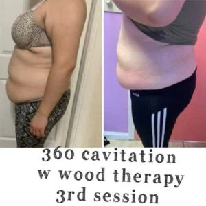 Legs before and after cavitation and wood therapy treatment.