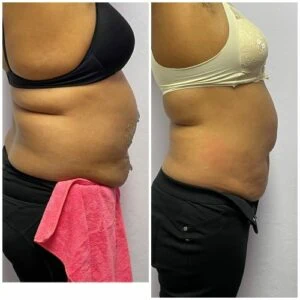 Woman in blue pants showing before and after stomach contouring.
