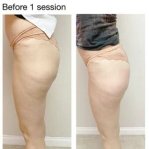 Thighs before and after visible slimming after one session.