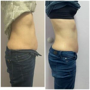 Comparison of woman’s waist after body fat reduction sessions.