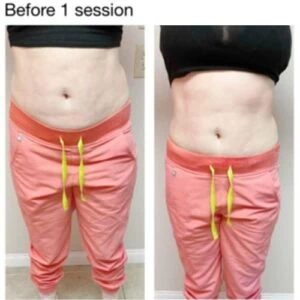 Female thigh area before and after fat removal treatment.