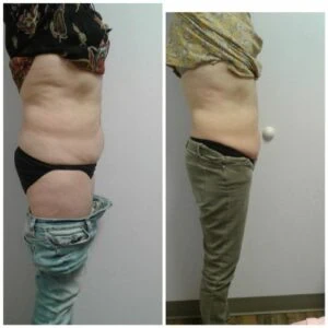 Abdominal region before and after body contouring results.