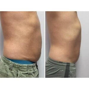 before and after fat removal treatment.