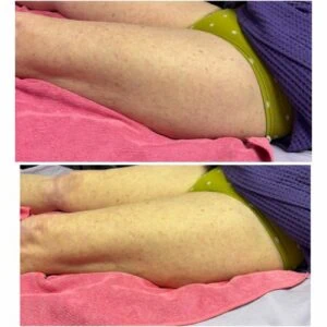 Before and after of a woman’s core area post slimming application.
