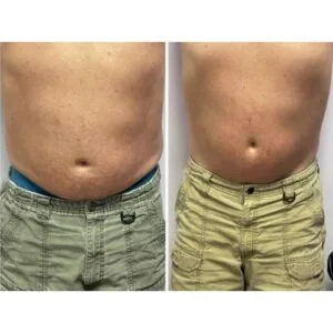 Waist area fat reduction | side-by-side before and after transformation.