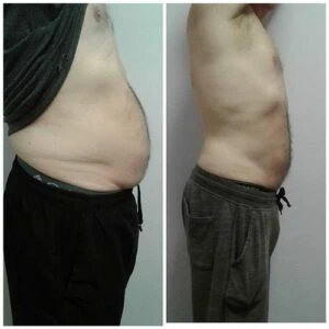 Comparison of lower abdomen before and after a skin tightening treatment.