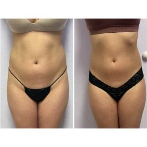 Abdomen sculpting before and after photo after multiple sessions.