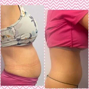 Woman wearing different outfits in before and after slimming photos.