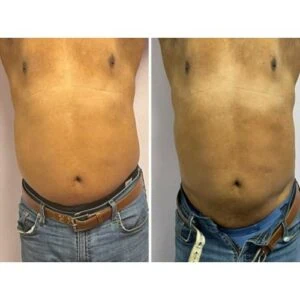 Female body before and after non-invasive slimming therapy.