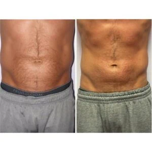 Visible waistline improvement before and after fat loss session.