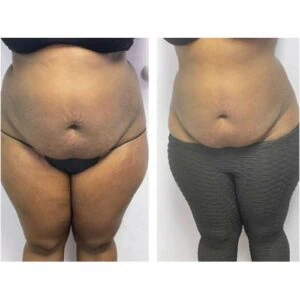 Belly fat reduction progress shown in before and after images.