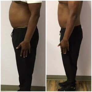 Male side profile showing visible fat reduction before and after.